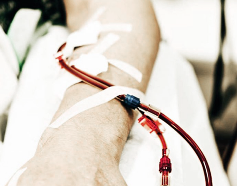 Armen til en pasient som får hemodialysebehandling hjemme